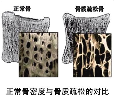 骨密度仪品牌为您分析导致骨质疏松的其他因素