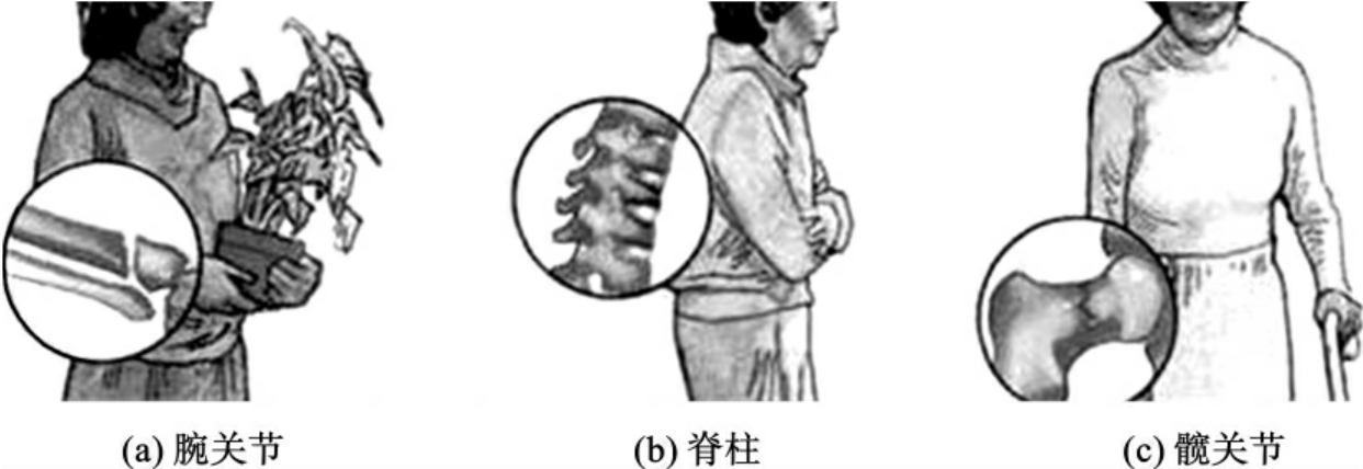 骨密度仪专家指出骨质疏松症病人易发生骨折的部位有这些