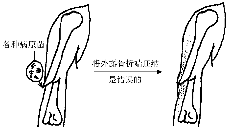 骨密度仪检测中心研究发现骨折治疗的主要方面有哪些？