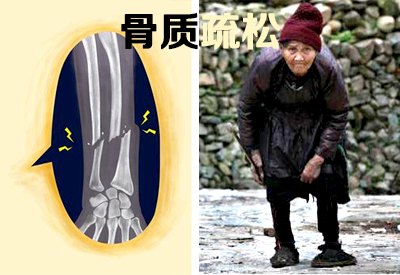 骨密度仪哪个品牌好?-近百家机构会选择这款骨密度骨质疏松症易患福利 骨密度仪哪个品牌好?-近百家机构会选择这款骨密度骨质疏松症易患福利